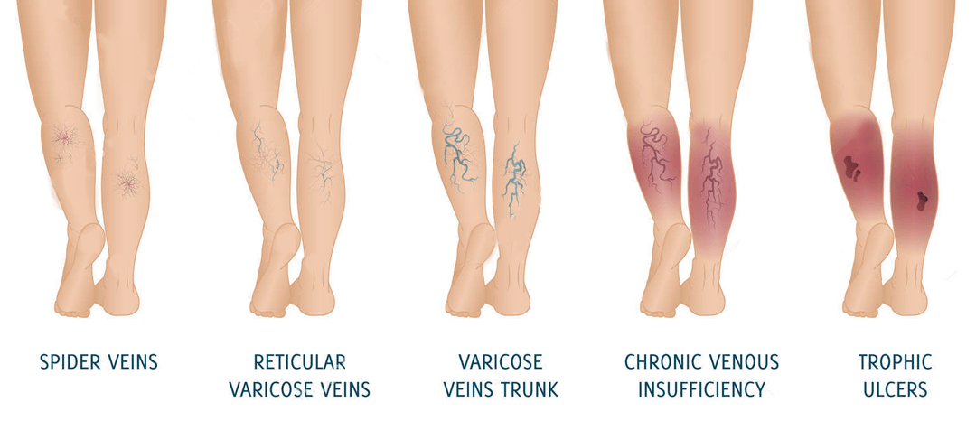 Laser Varicose Veins treatment