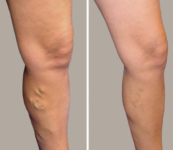 Varicose Veins treatment in Chennai