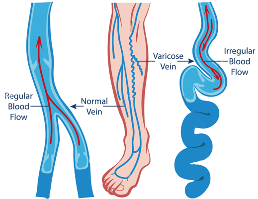 chennai-varicose-surgery